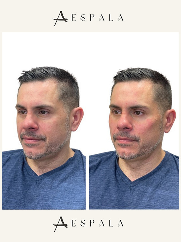 Cheek Fillers Before & After Image