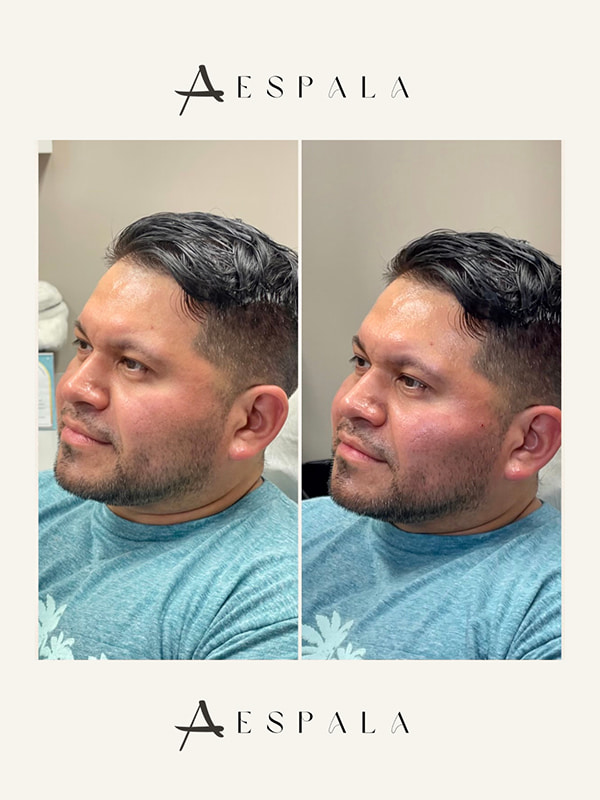 Cheek Fillers Before & After Image