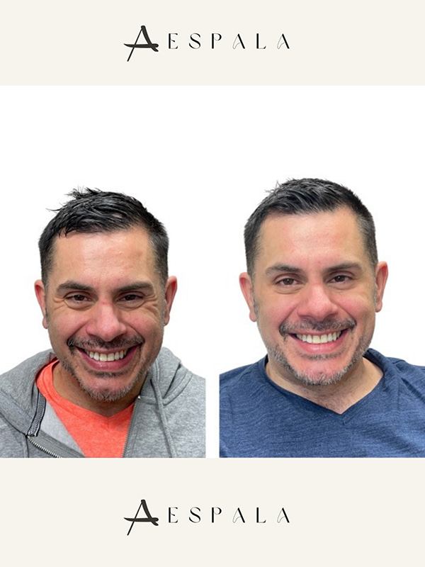 Crows Feet Before & After Image