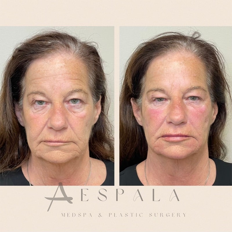 Dermal Filler Before & After Image