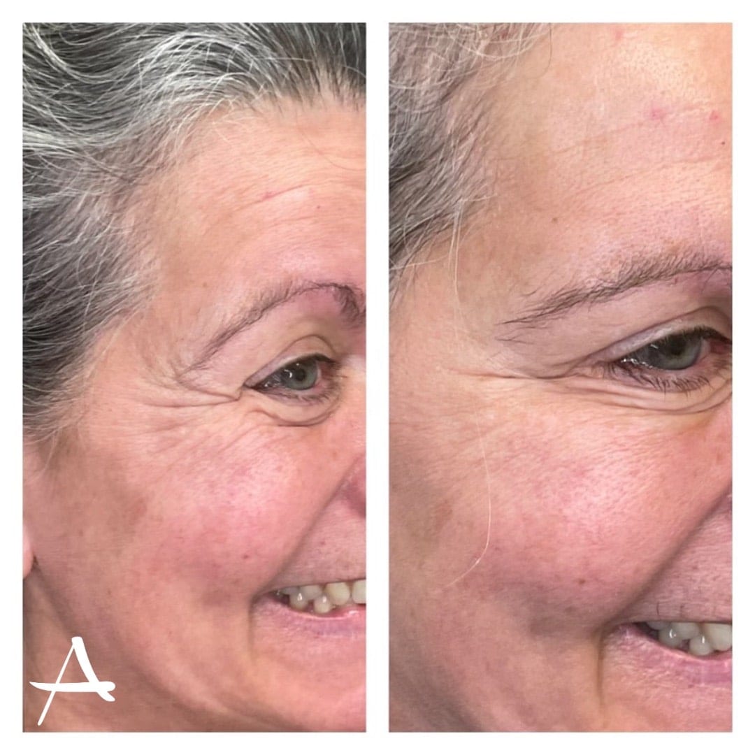 Dysport Before & After Image