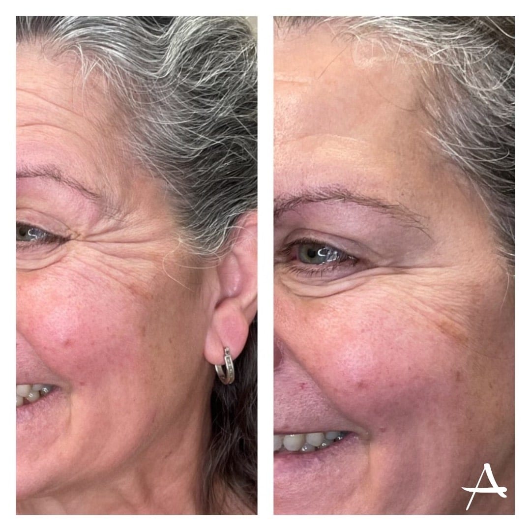 Dysport Before & After Image