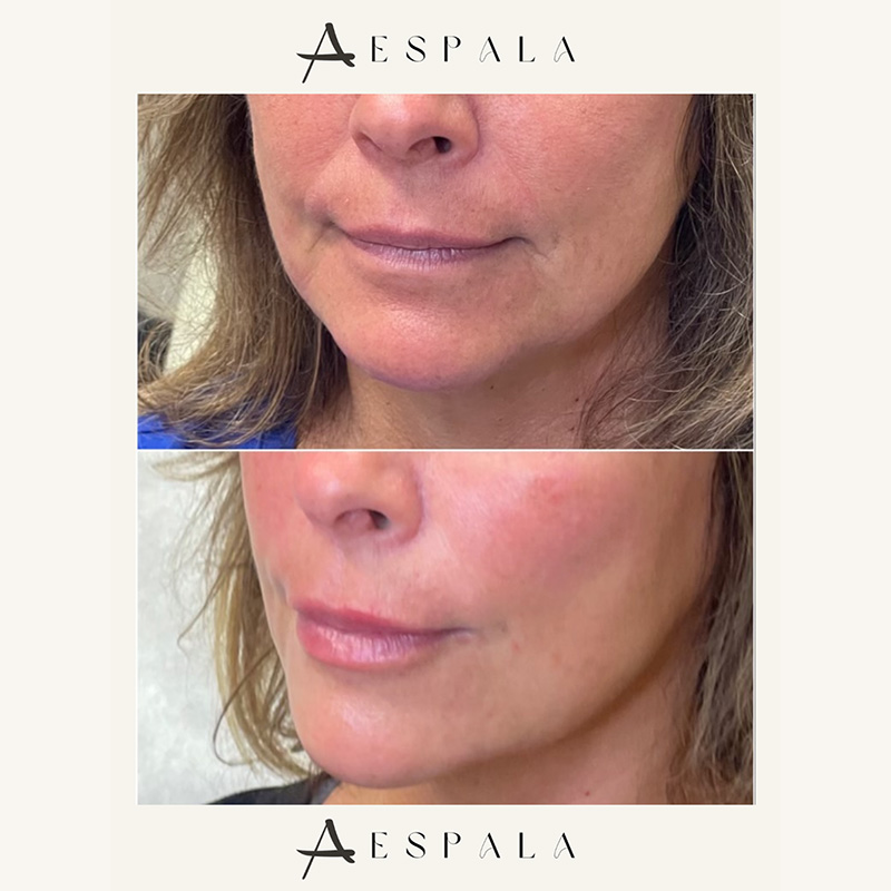 Dysport Before & After Image