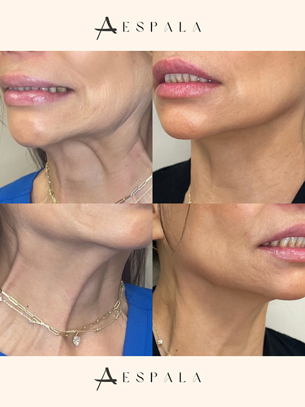 Dysport Before & After Image