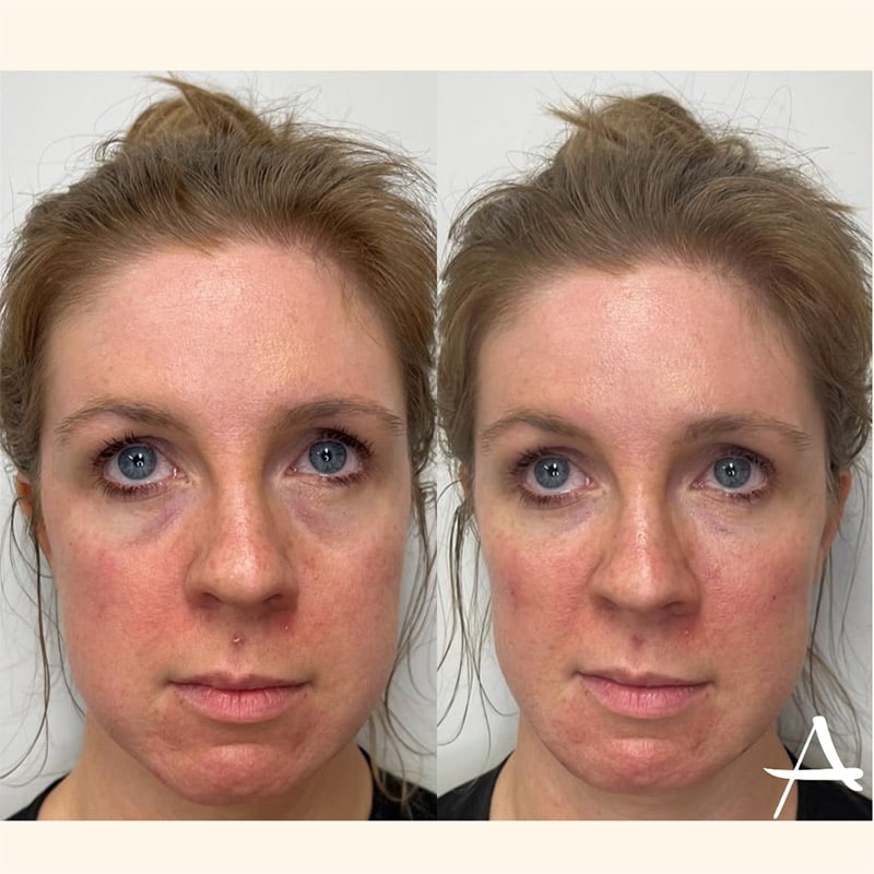 EZ Gel Before & After Image