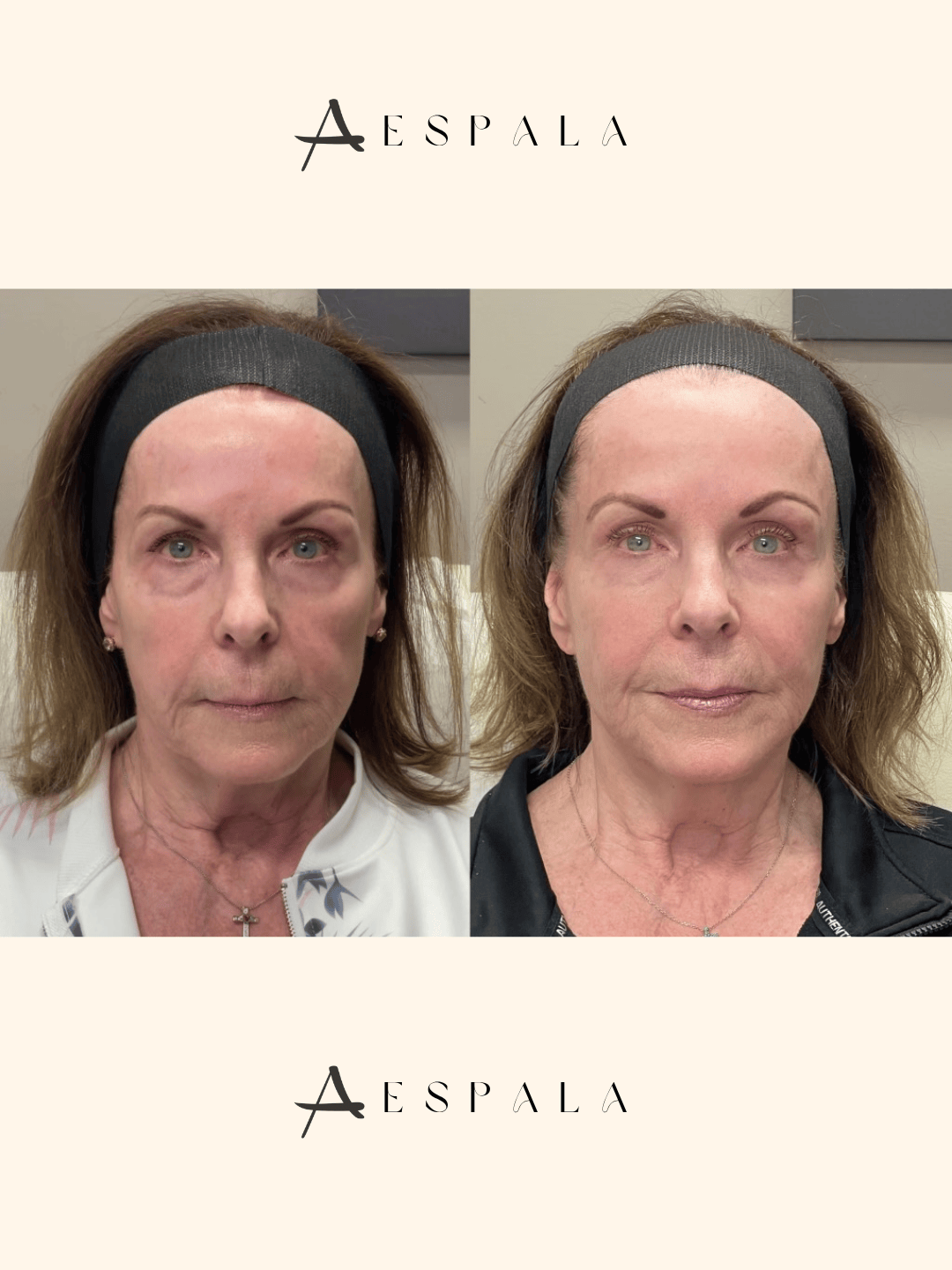 Full Facial Balancing Before & After Image