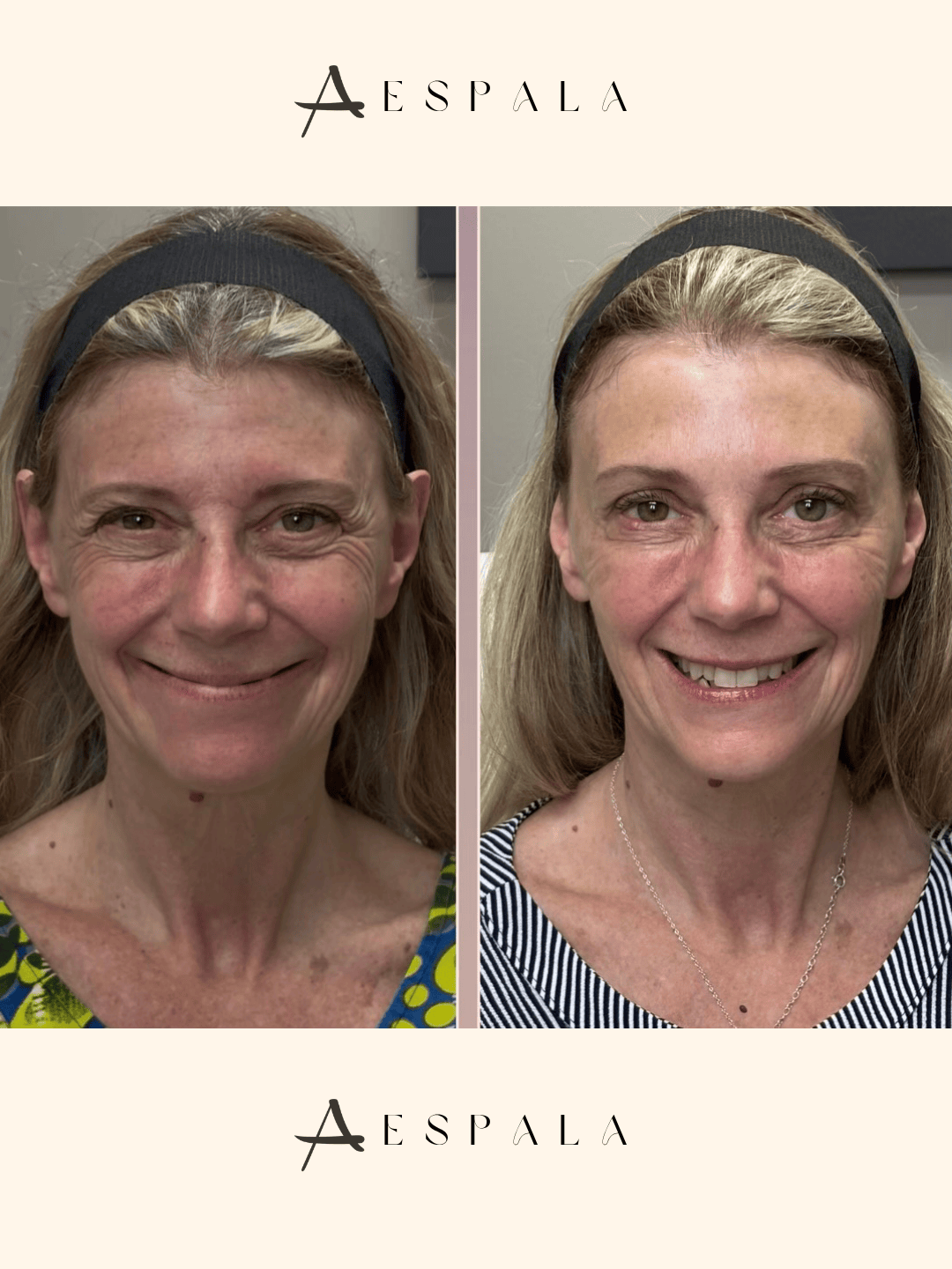 Full Facial Balancing Before & After Image