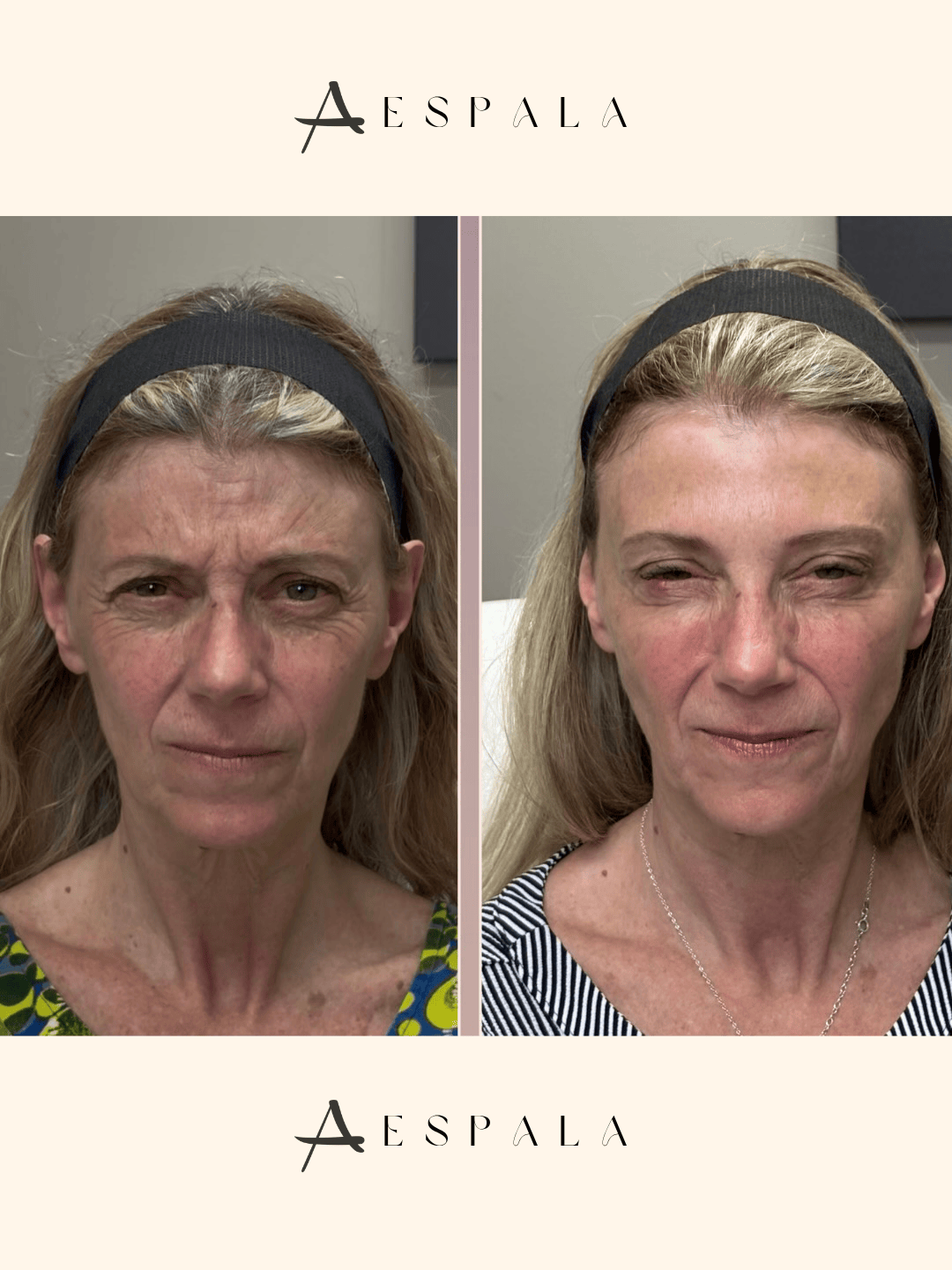 Full Facial Balancing Before & After Image