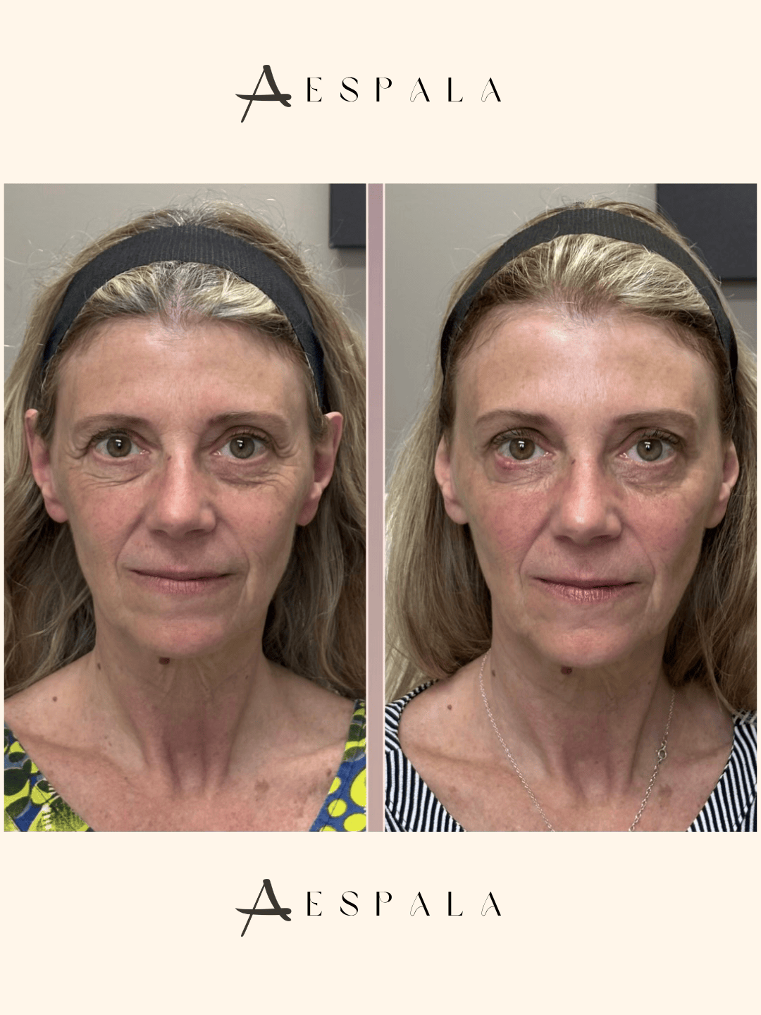 Full Facial Balancing Before & After Image