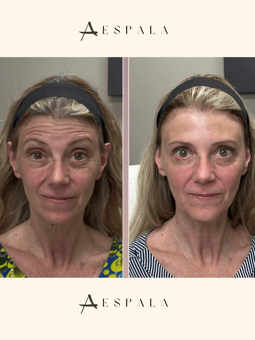Full Facial Balancing Before & After Image