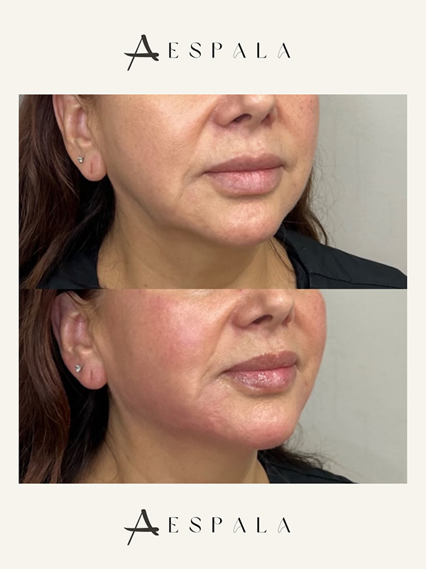 Jawline Filler Before & After Image