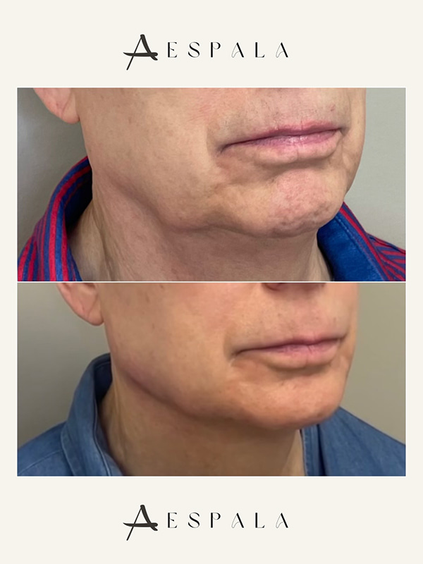 Jawline Filler Before & After Image