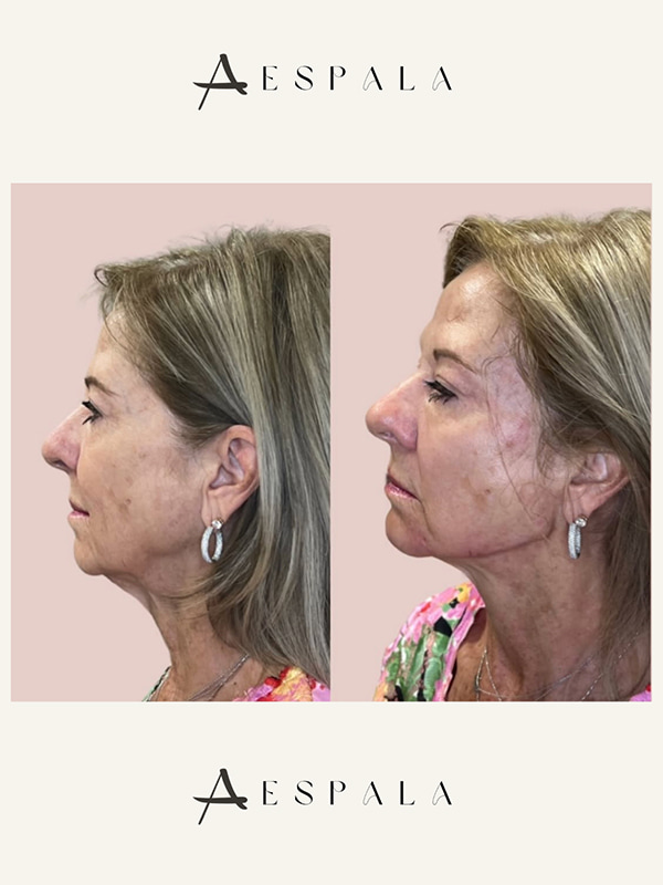 Jawline Filler Before & After Image