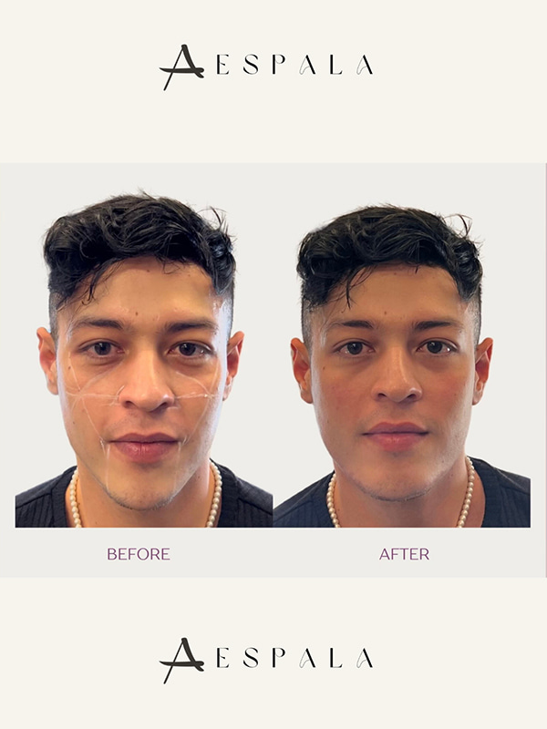 Jawline Filler Before & After Image
