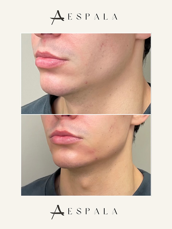 Jawline Filler Before & After Image