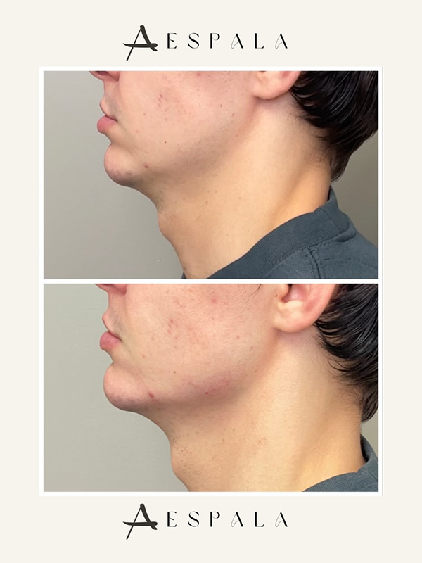 Jawline Filler Before & After Image
