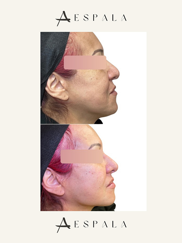 Jawline Filler Before & After Image