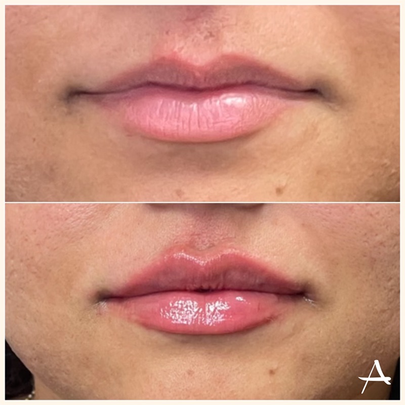 Lip Fillers Before & After Image