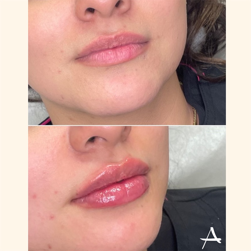 Lip Fillers Before & After Image