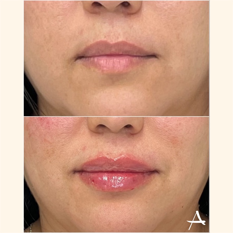 Lip Fillers Before & After Image
