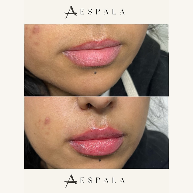 Lip Fillers Before & After Image