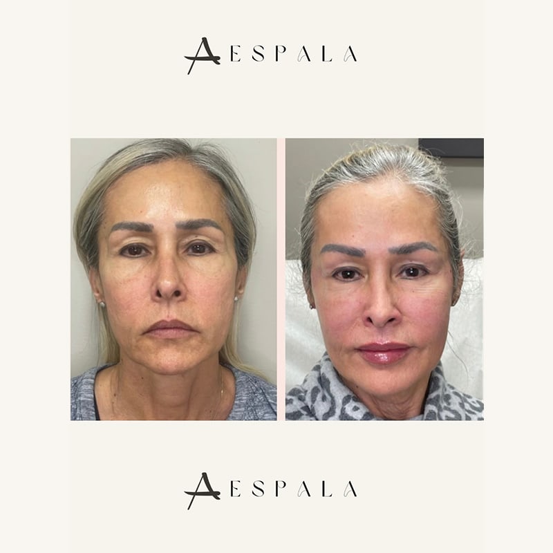 Lip Fillers Before & After Image