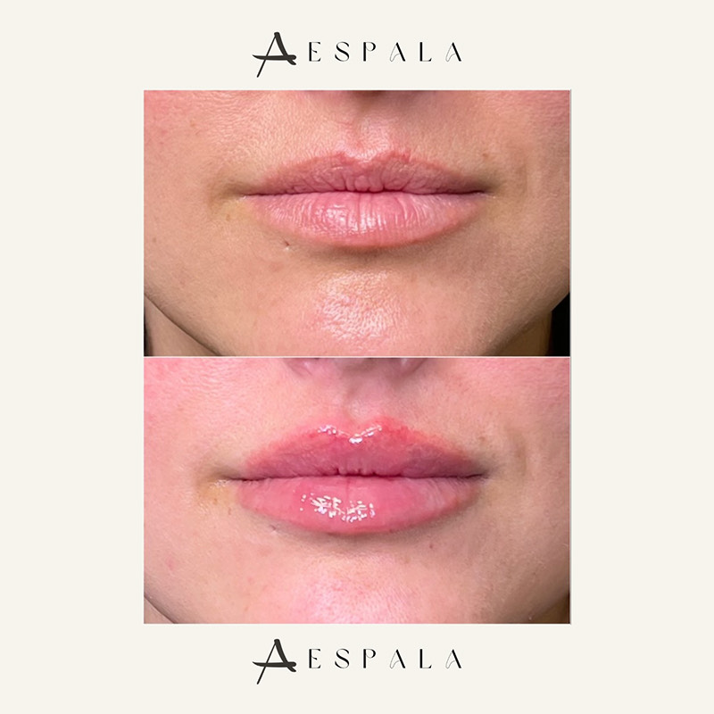 Lip Fillers Before & After Image