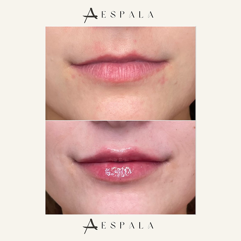 Lip Fillers Before & After Image