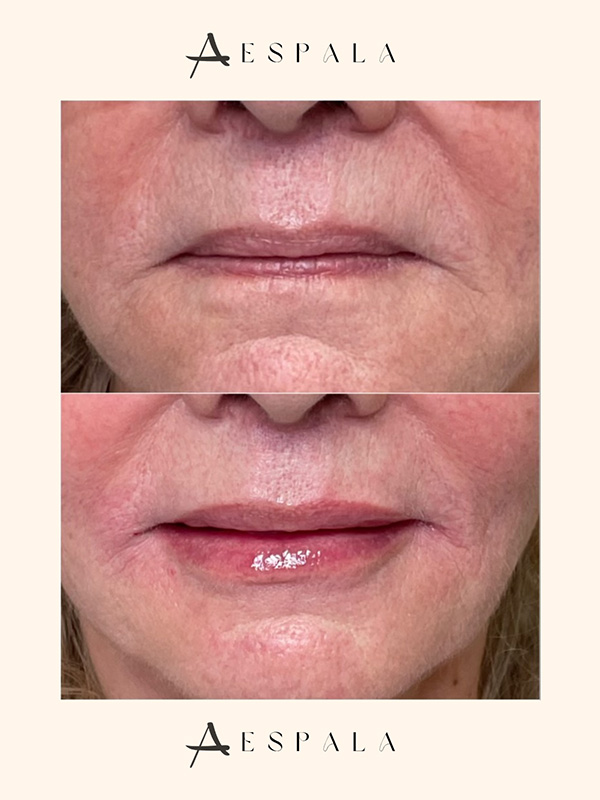 Lip Fillers Before & After Image