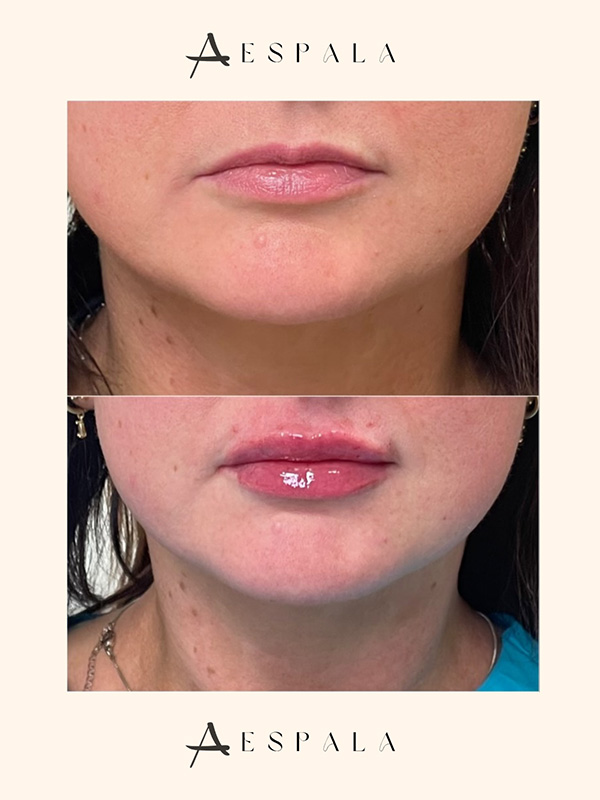 Lip Fillers Before & After Image