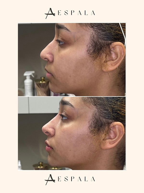 Nose Filler Before & After Image