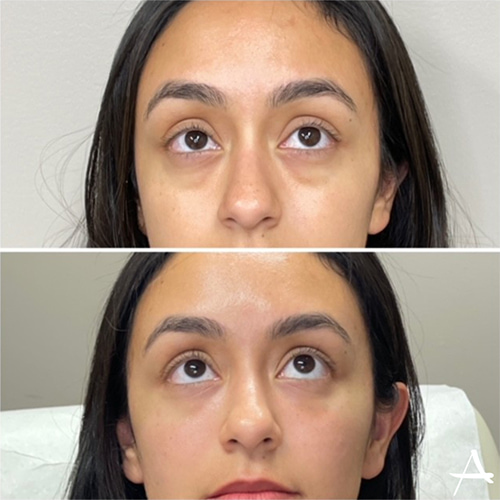 PRF Fillers Before & After Image