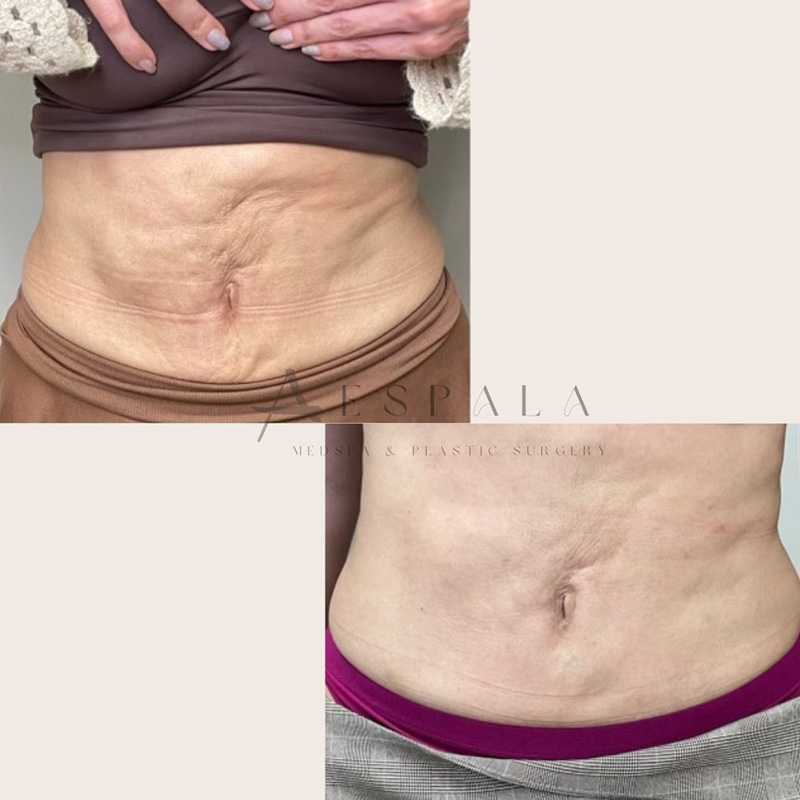Sculptra Before & After Image