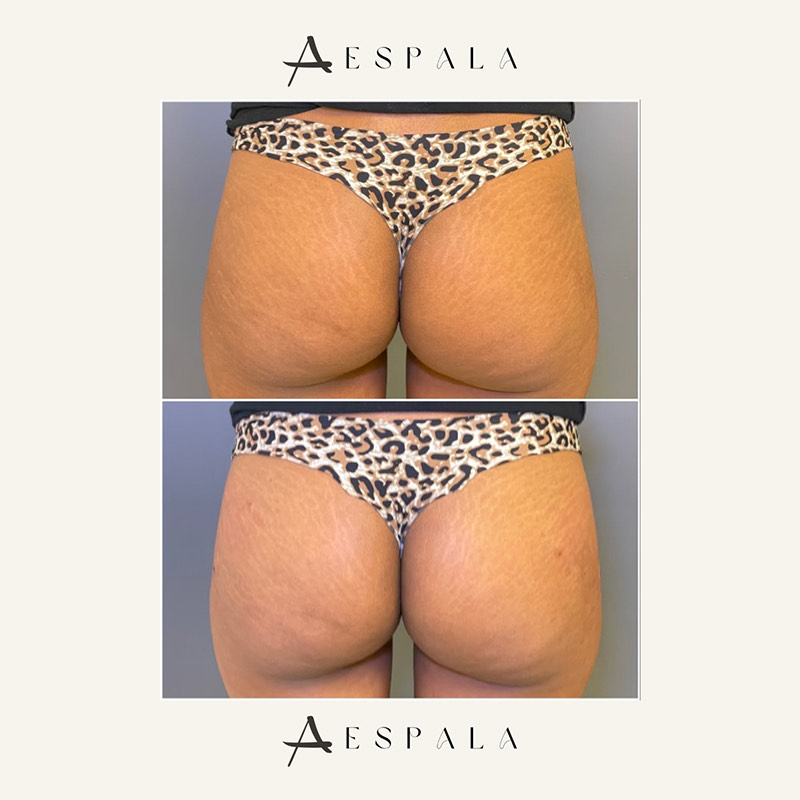 Sculptra Before & After Image