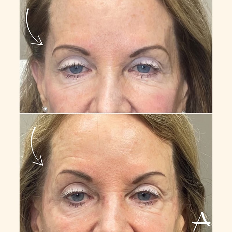 Temple Filler Before & After Image
