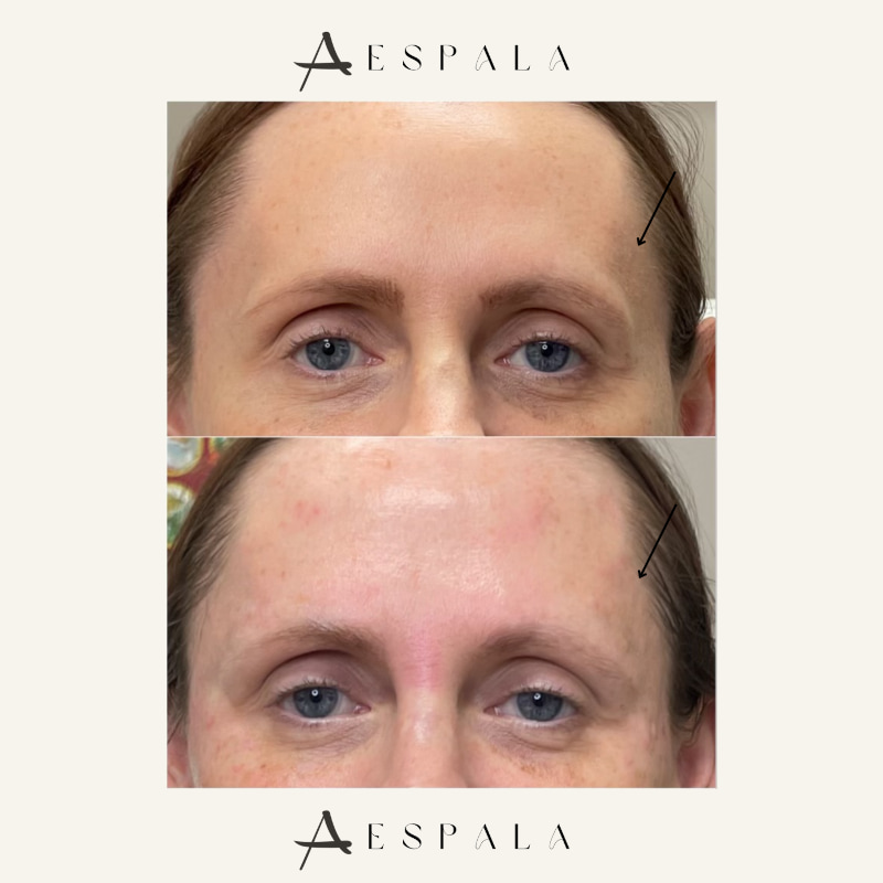 Temple Filler Before & After Image