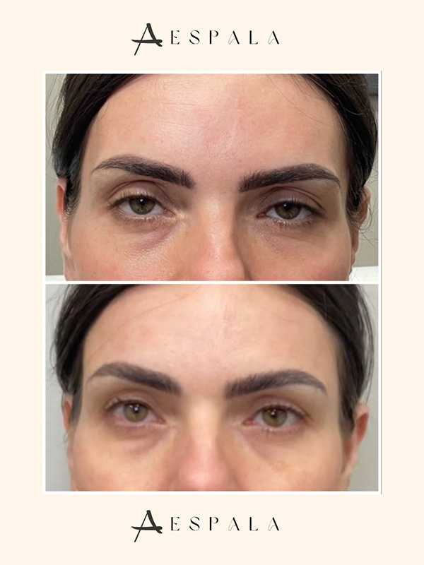 Temple Filler Before & After Image