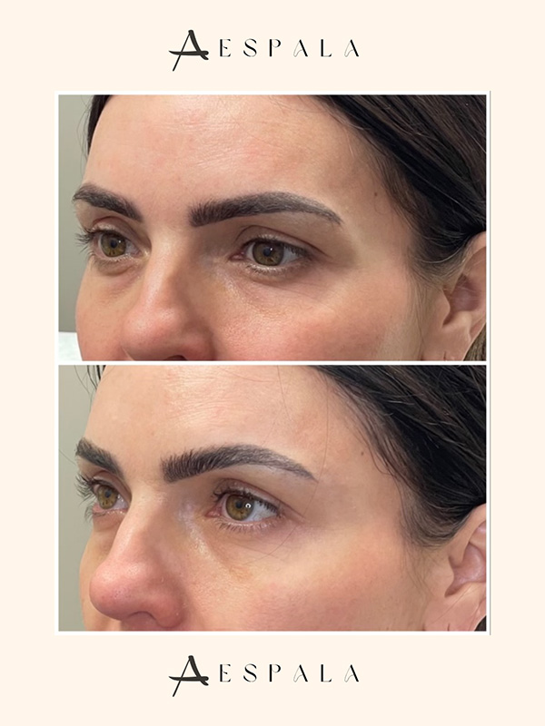 Temple Filler Before & After Image
