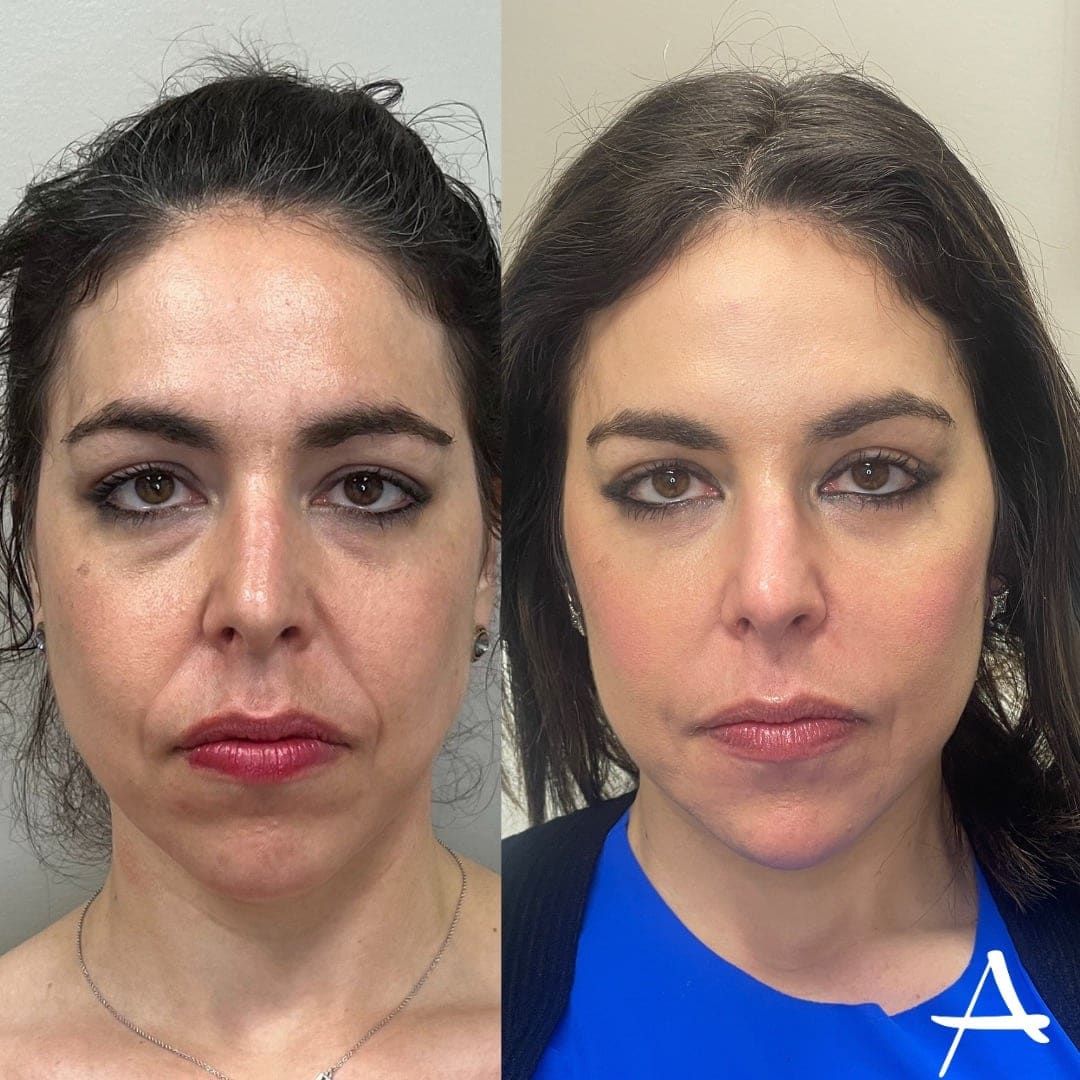 Undereye Filler Before & After Image
