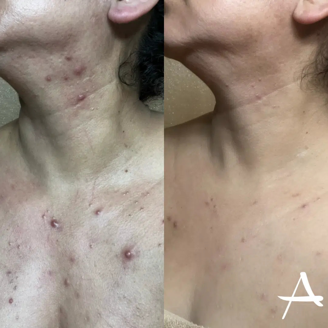 Chemical Peels Before & After Image