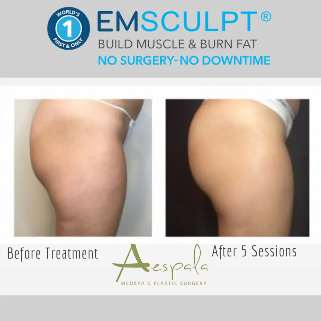 Emsculpt Before & After Image