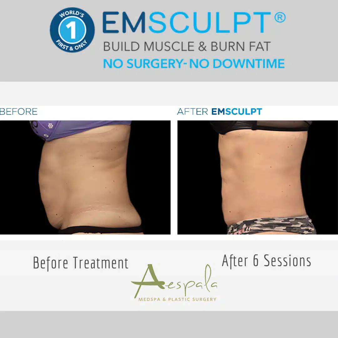 Emsculpt Before & After Image