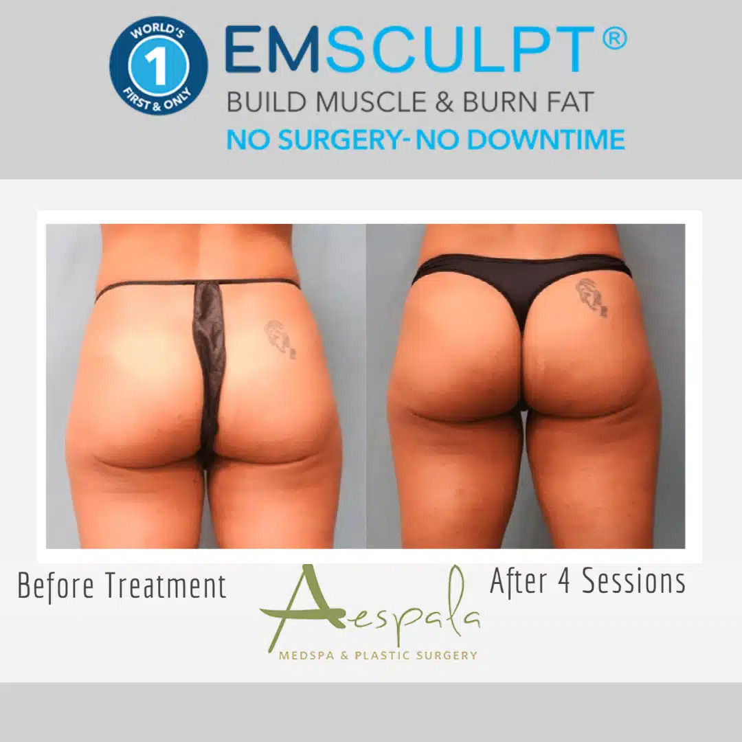 Emsculpt Before & After Image