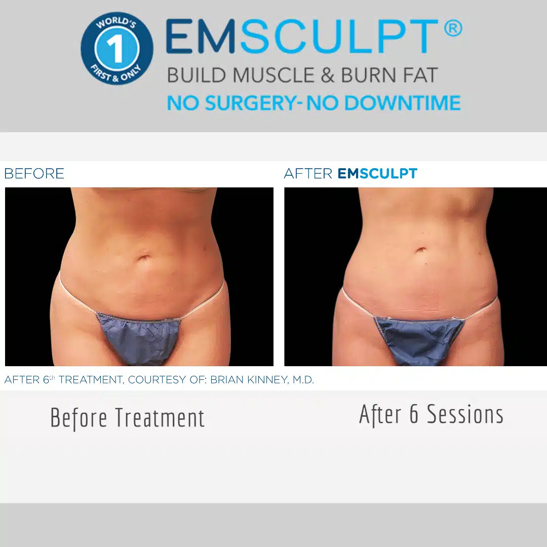 Emsculpt Before & After Image