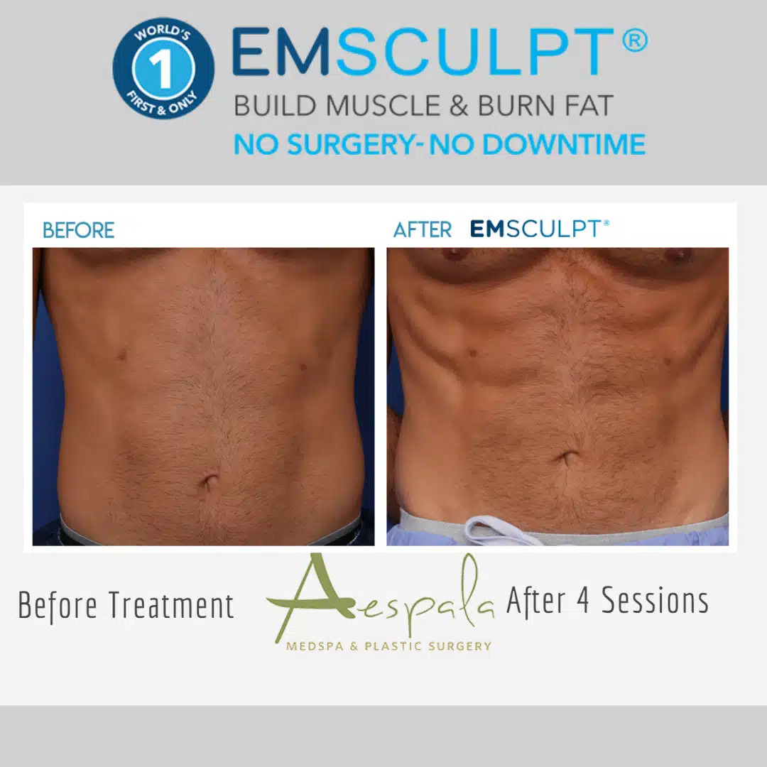 Emsculpt Before & After Image