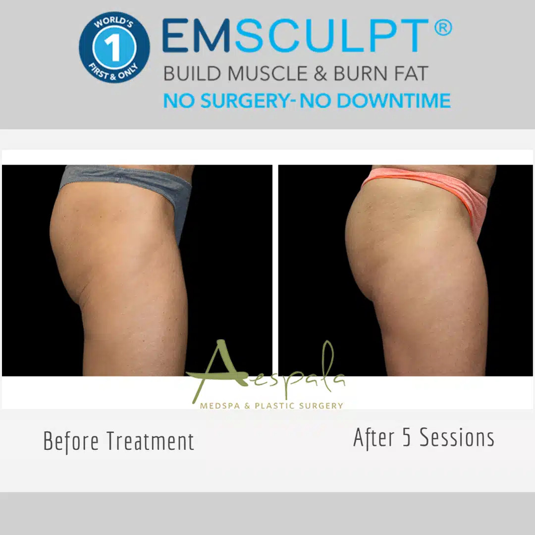 Emsculpt Before & After Image