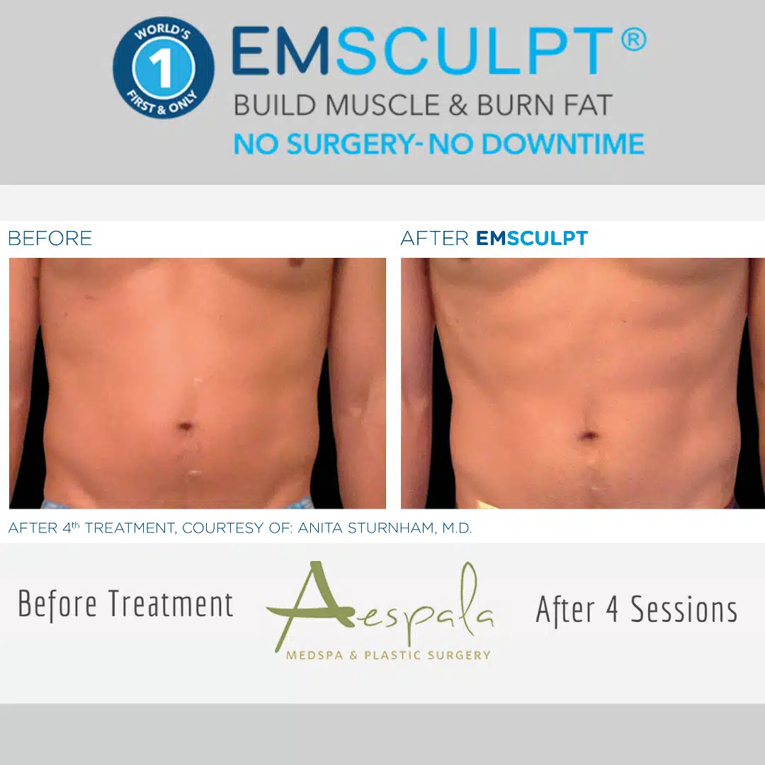 Emsculpt Before & After Image