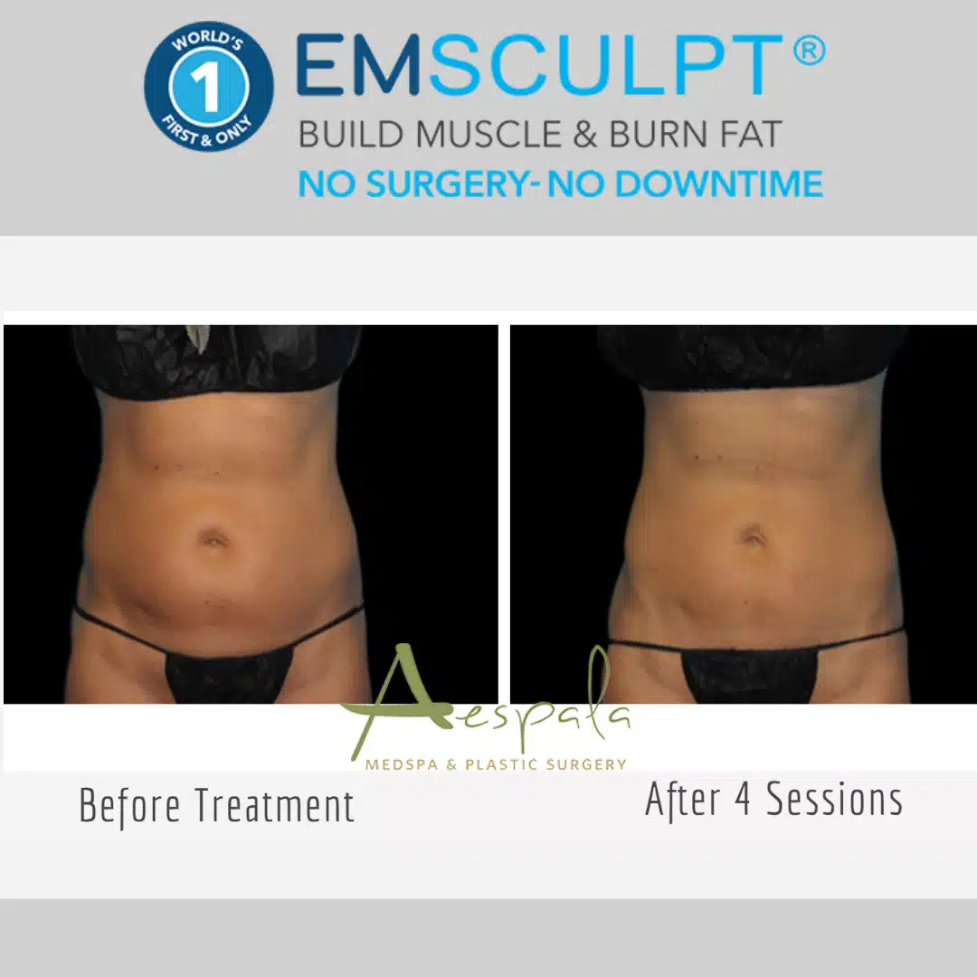 Emsculpt Before & After Image