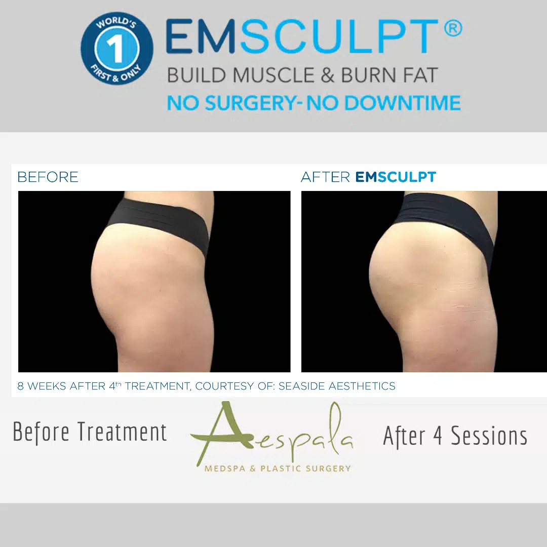 Emsculpt Before & After Image