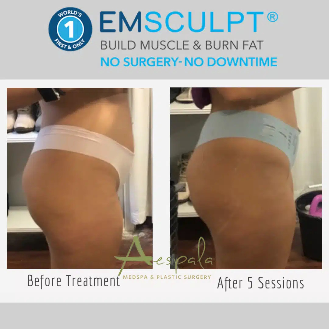 Emsculpt Before & After Image